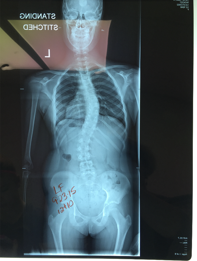 Junior+Leah+Farner+Recovers+From+Scoliosis