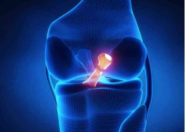 Highlighted anterior cruciate ligament.