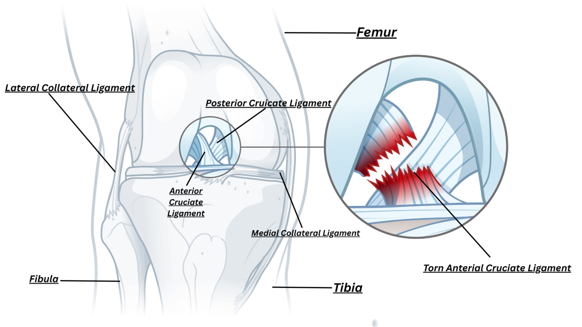 ACL tears: How do they impact athletes?